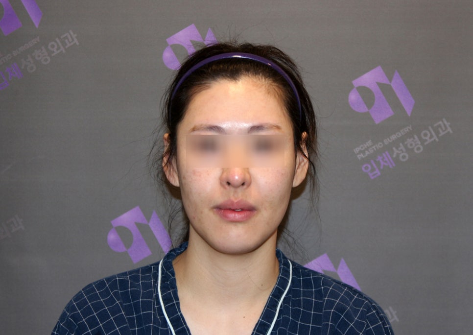 Long Midface and Lower Face Long-Face, Long-Chin Surgery - Cases That Do Not Require Double-Jaw Surgery image 3