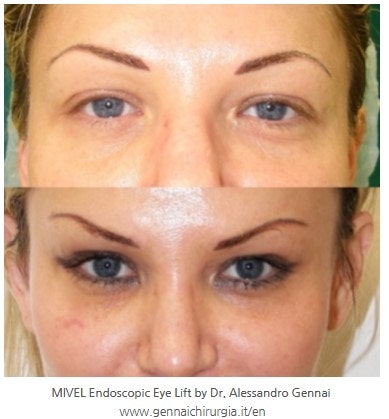 How Far Should Forehead Lift Dissection Go? Is More Fixation Always Better? image 5