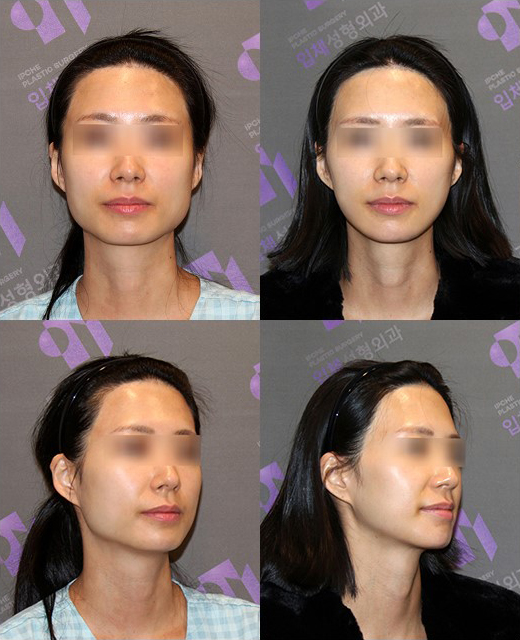 사각턱교정, 긴곡선 사각턱수술과 귀뒤사각턱의 차이와 CT분석 관련 이미지 10