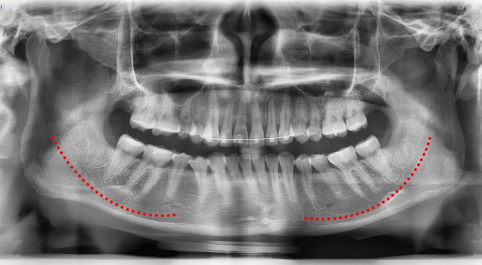 If the nerve line is low, can’t you have jaw angle surgery? Is there any way to make the front view slimmer? image 2