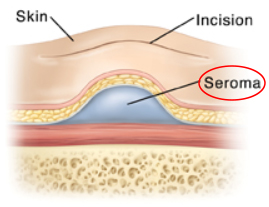 Why Is a Blood Drain Bag Used After Facelift Surgery? image 2