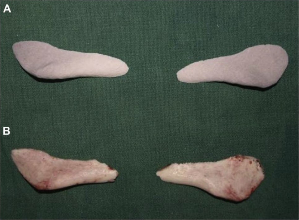 [논문 리뷰] 사각턱 뼈가 줄어들면 실제 내 얼굴은 얼마나 작아지나요? 관련 이미지 3