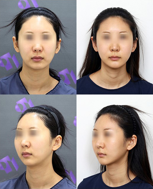 원장님, 윤곽수술하면 예뻐지는 게 맞나요? 관련 이미지 10