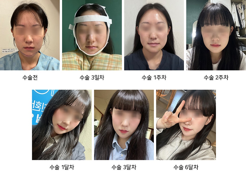 How to Reduce Swelling Quickly After Facial Contouring Surgery - Explained by a Plastic Surgeon image 2
