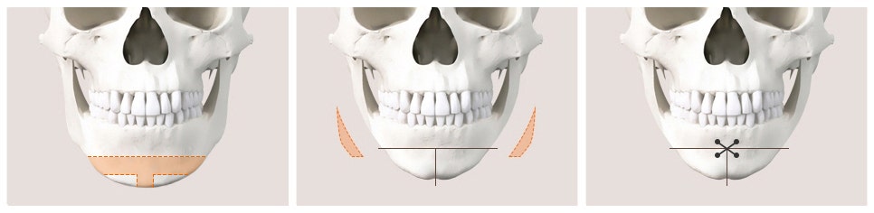 T-Genioplasty Techniques That Vary Depending on the Shape of the Chin image 9
