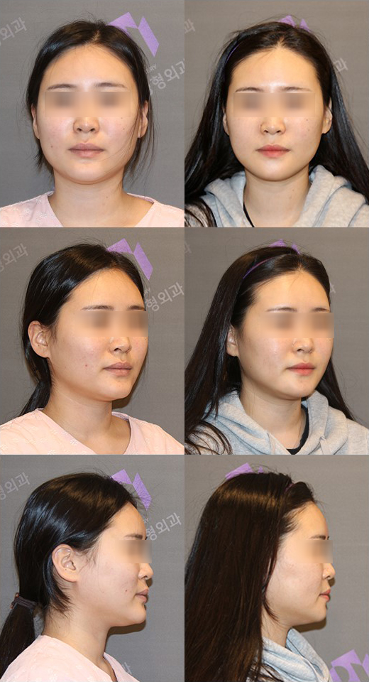 주걱턱은 어떤 수술을 해야 할까요? 관련 이미지 10