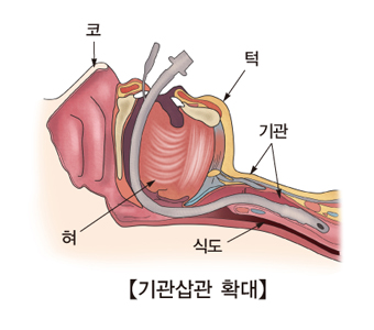 윤곽수술 후 기침과 피가래, 왜 생기고 언제까지 지속될까요? 관련 이미지 3