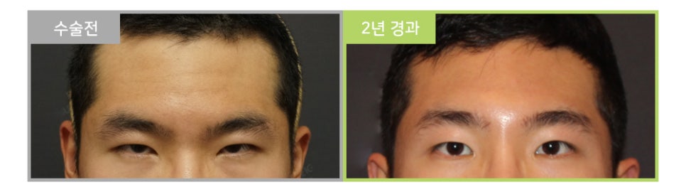 처진 눈과 눈매교정이 눈수술이 아닌 이마눈썹거상술을 해야한다고? 관련 이미지 5