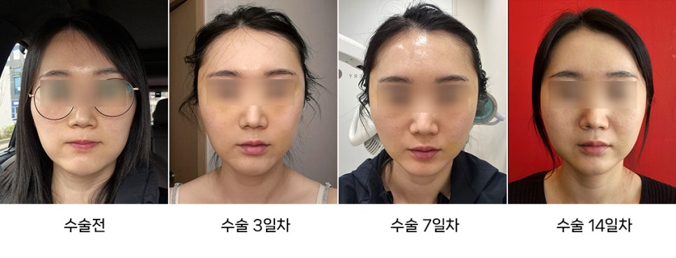 The Difference Between Swelling and Cheek Sagging After Facial Contouring Surgery image 1