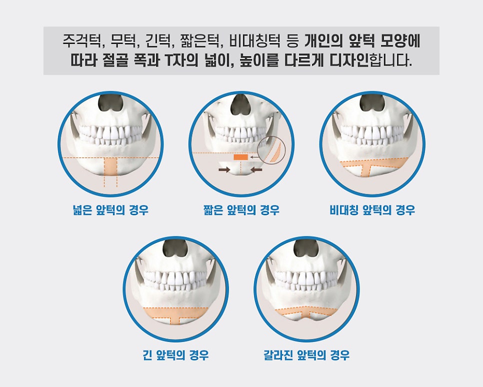 T-Genioplasty Techniques That Vary Depending on the Shape of the Chin image 2