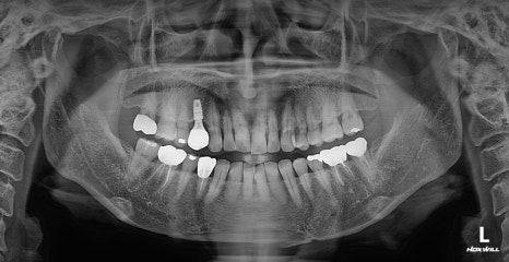 Are There Cases Where Pin Removal Is Difficult After Double Jaw or Contouring Surgery? image 5