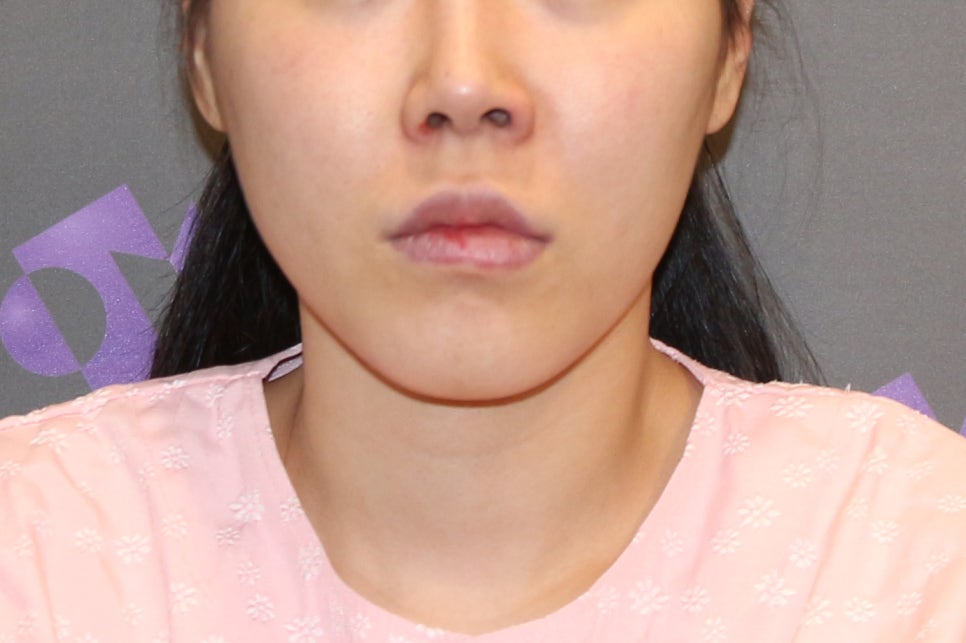 Is T-Osteotomy Better for Chin Surgery? - Explained by a Specialist image 4