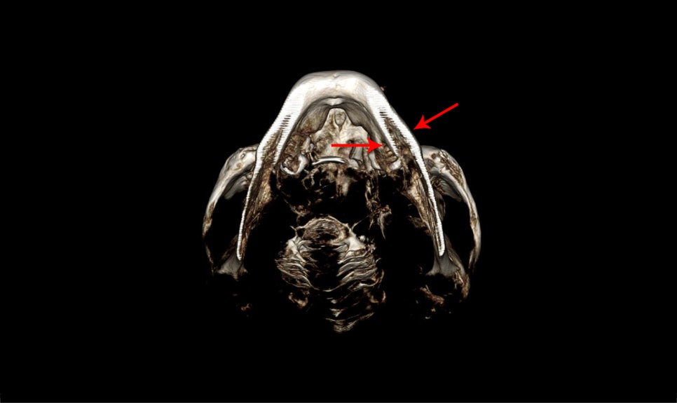 V-Line Square Jaw Surgery Is Good for the Front View Effect image 9