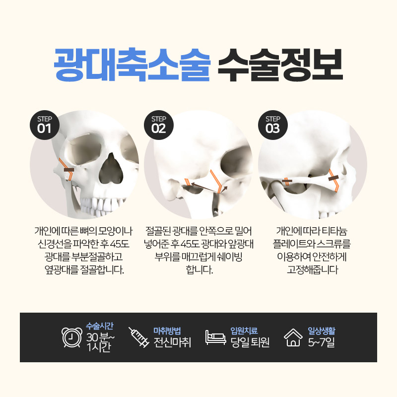 안면윤곽수술, 처음부터 끝까지 A to Z 관련 이미지 6