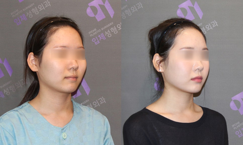 광대수술의 역사, 광대축소술 절골 방법에 대해서 관련 이미지 14