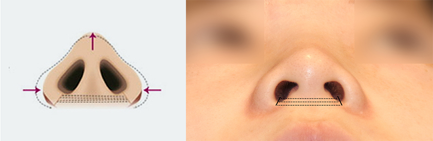 Incisional or Non-incisional? A Review of Alar Reduction Surgery Cases (Alar Base Reduction) image 7