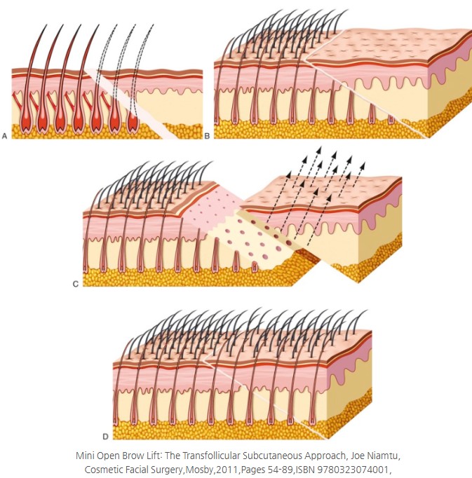 Key Techniques in Forehead Reduction Surgery - Trichophytic and W-Plasty Incisions image 2