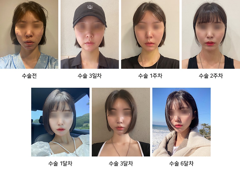 How to Reduce Swelling Quickly After Facial Contouring Surgery - Explained by a Plastic Surgeon image 5