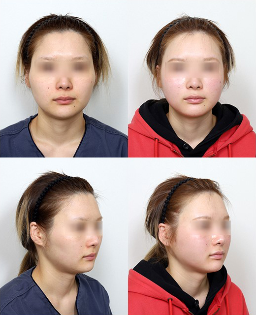 Zygoma Reduction Surgery: Effects and Differences Between 230-Degree and 3D Zygoma Reduction image 8
