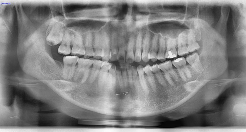 [Chin Surgery] Learning About Contouring Shave and T-Osteotomy with Real Patient Cases (2) image 3