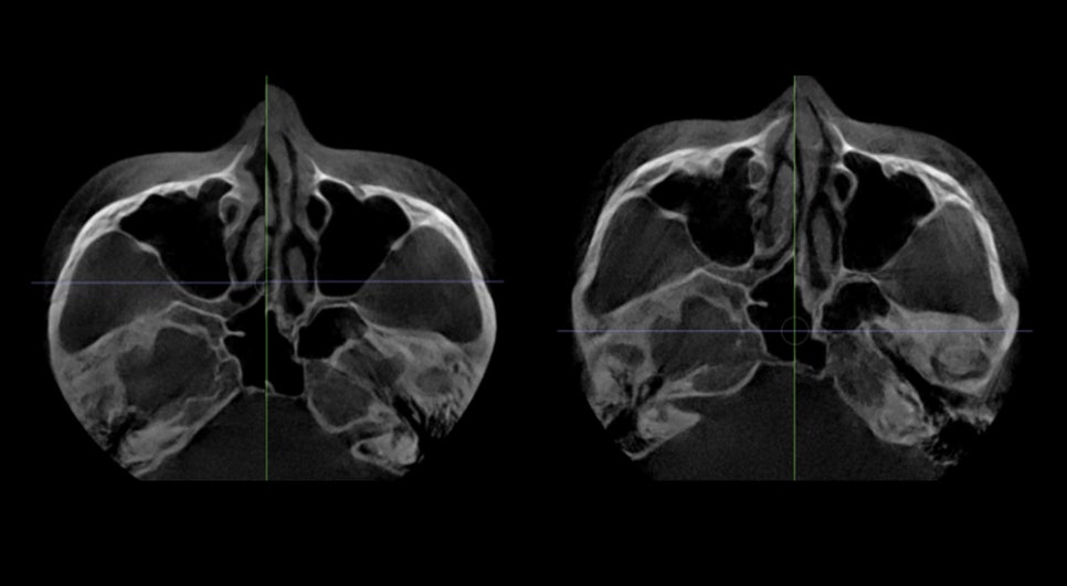 Non-fixation zygoma reduction surgery, will the bone heal properly? image 5
