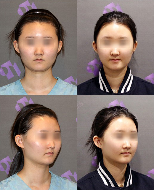 광대축소술, 내 광대뼈는 얼마나 줄어들 수 있나요? 관련 이미지 9