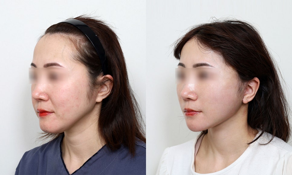 When Are Facial Contouring Surgery and Facelift Surgery Needed Together? image 3