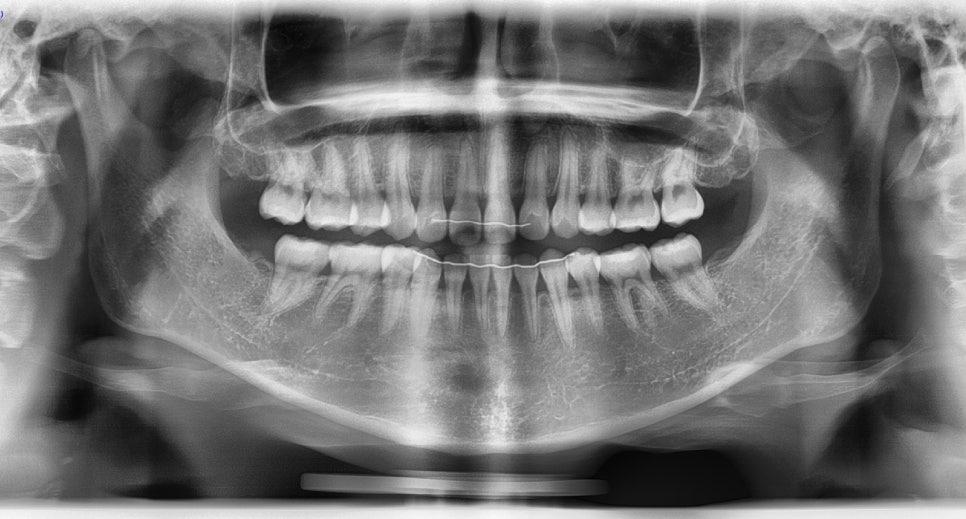 Long Chin, Long Face Contouring - Cases That Do Not Require Double Jaw Surgery image 9