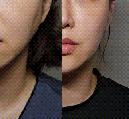 Post-Contour Surgery Cheek Hollowing and a Bumpy Jawline: Cases of Soft Contouring and Facelift Surgery image 3