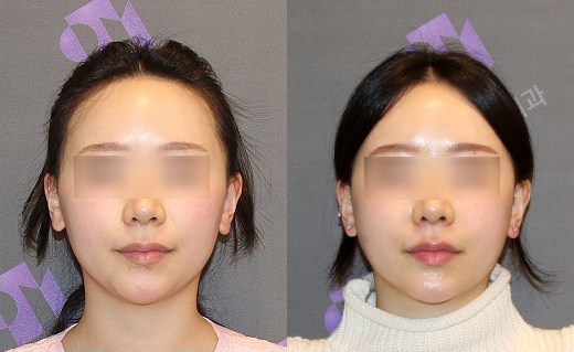 230도 입체 광대축소술로 재수술도 가능할까요? 관련 이미지 12