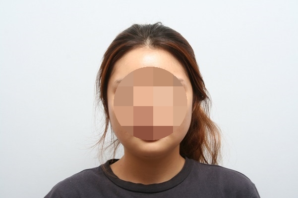 옆광대축소술 정말 효과가 없나요? 관련 이미지 4