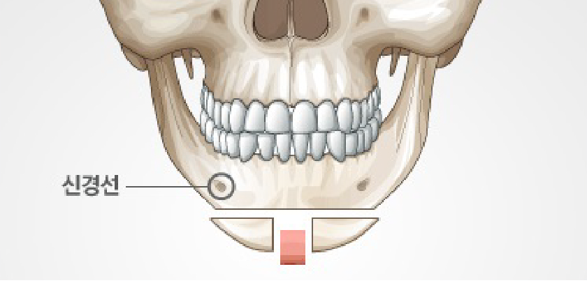 Is T-Osteotomy Better for Chin Surgery? - Explained by a Specialist image 1