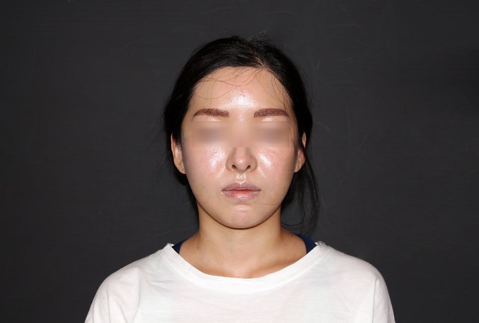 230도입체광대축소술로 재수술이 가능한 경우가 있을까요? 관련 이미지 18