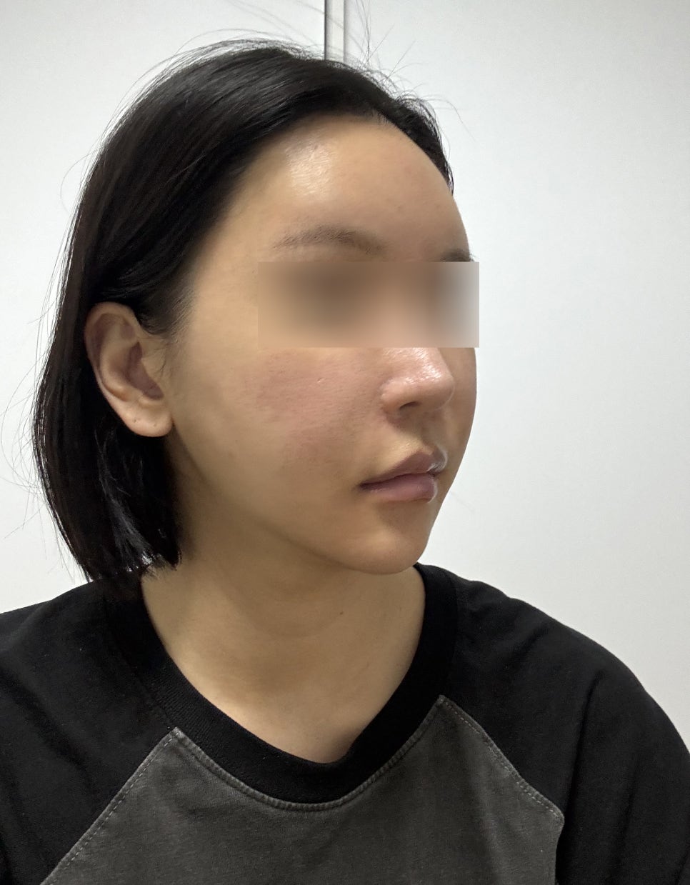 The Real Cause of What Feels Like Cheek Sagging After Contouring Surgery image 2