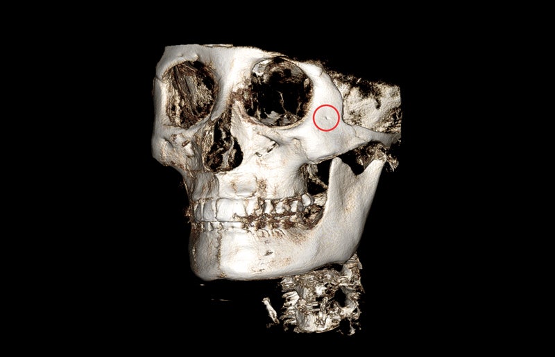 A Complete Summary of 6 Complications After Cheekbone Surgery: Sinusitis, Recurrence, Hollow Cheeks, and Sagging Cheeks image 11