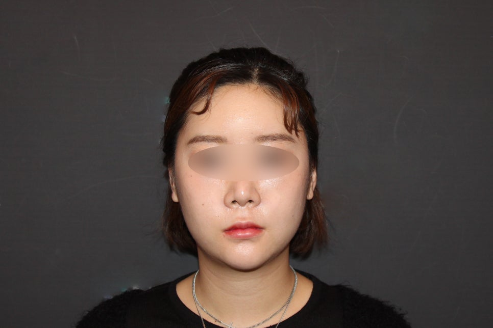 Facial Contouring Swelling, When Can I Go Back to Work? - A Specialist Explains Directly [입체성형외과] image 2