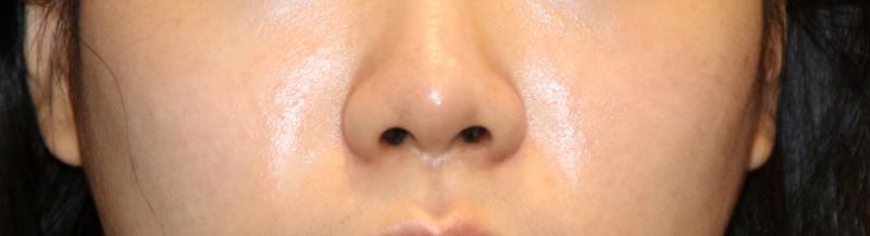 Is There a Nose Alar Reduction Surgery Without Scarring? (Looking at Before-and-After Photos) image 14