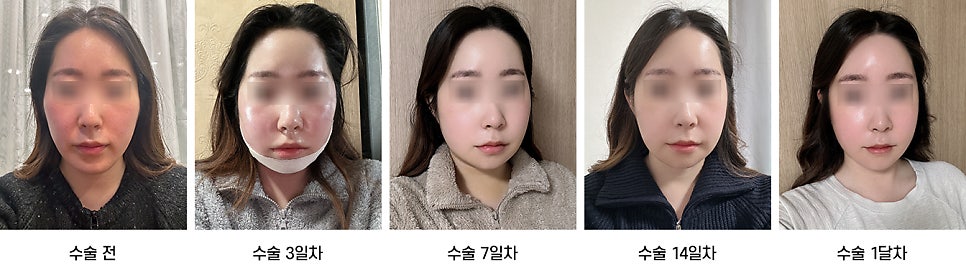 안면윤곽 수술 후 붓기, 일상생활은 언제부터 가능한가요? 케이스별로 알아보기 관련 이미지 10