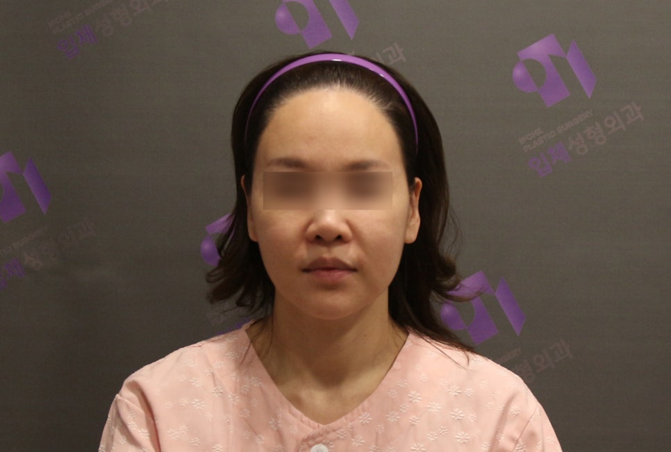 안면윤곽 볼처짐 100%온다? 광대수술 부작용 관련 이미지 1