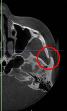 Will cheekbone reduction surgery also make the face smaller? : Learn about how to reduce prominent cheekbones with real surgical cases image 10
