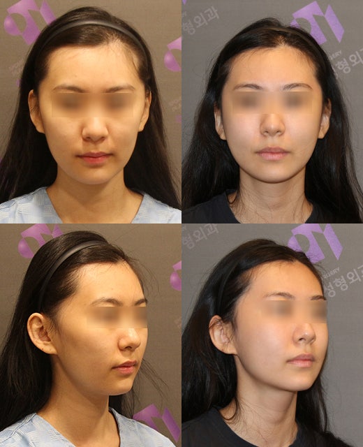 The Story After Cheek Dimple Correction image 6
