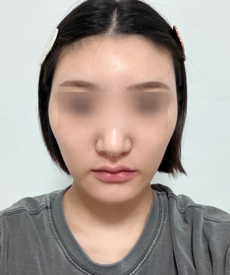 땅콩형 얼굴, 안면윤곽 수술로 해결할 수 있을까요? 관련 이미지 1