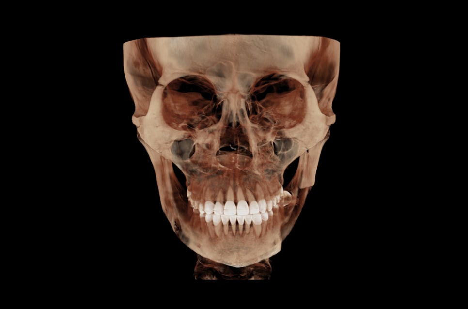 Square Jaw Surgery: The Difference Between Cortical Osteotomy and Lateral Cortical Shaving image 10