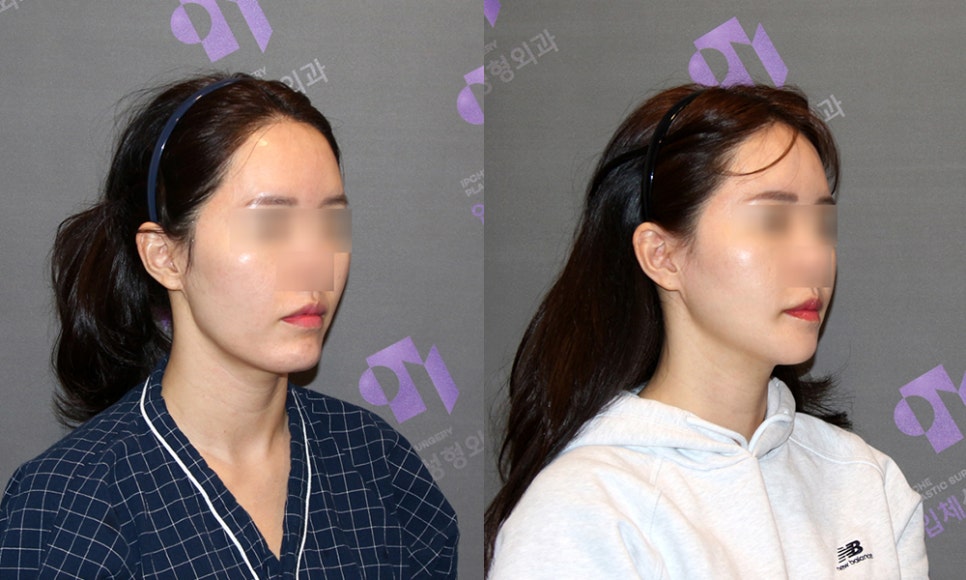 긴턱수술 후 중안면부 얼굴이 길어 보일까요? 관련 이미지 4