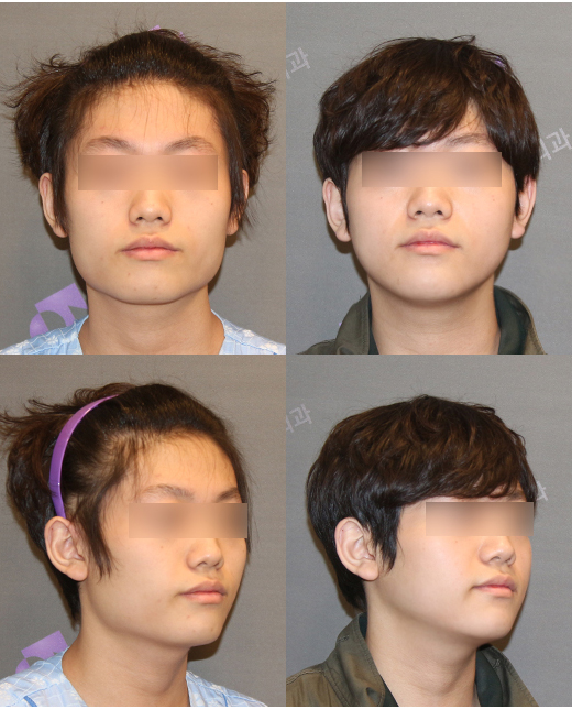 땅콩형 얼굴은 어떻게 개선할 수 있을까요? 관련 이미지 8