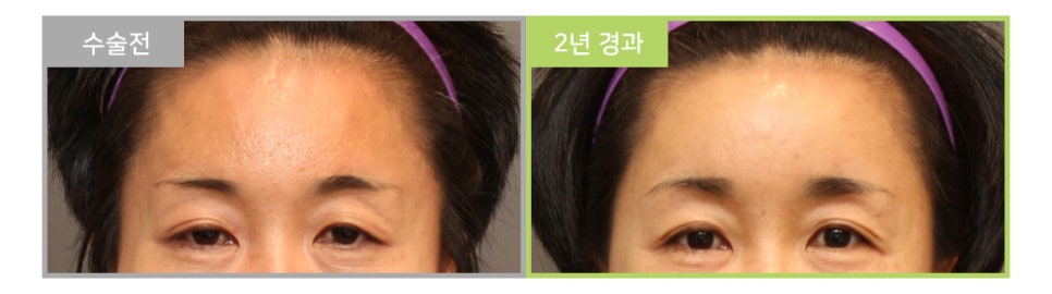 처진 눈과 눈매교정이 눈수술이 아닌 이마눈썹거상술을 해야한다고? 관련 이미지 3