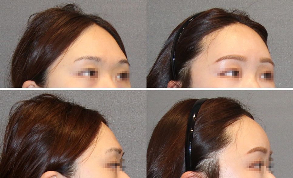 How Should a Prominent Brow Bone Be Addressed? image 1