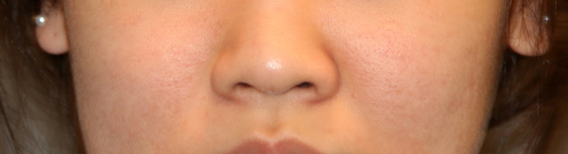 Is There a Nose Alar Reduction Surgery Without Scarring? (Looking at Before-and-After Photos) image 11