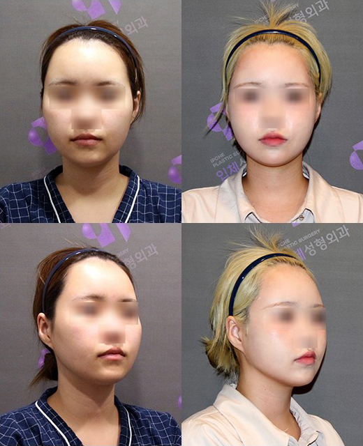 미성년자도 윤곽수술을 할 수 있나요? 관련 이미지 3