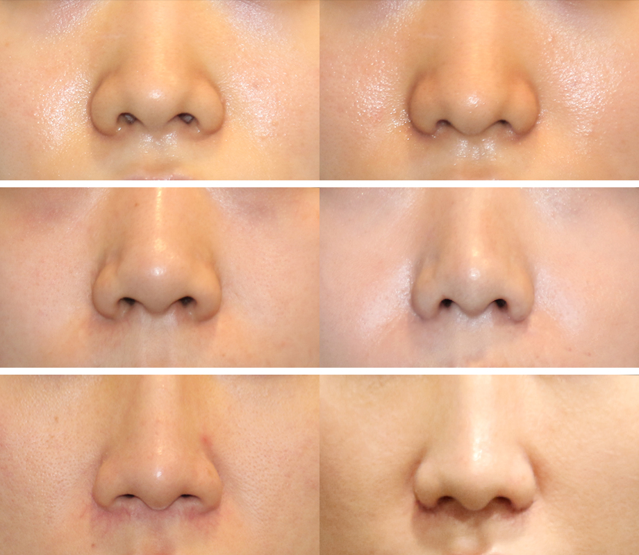 Incisional or Non-incisional? A Review of Alar Reduction Surgery Cases (Alar Base Reduction) image 6
